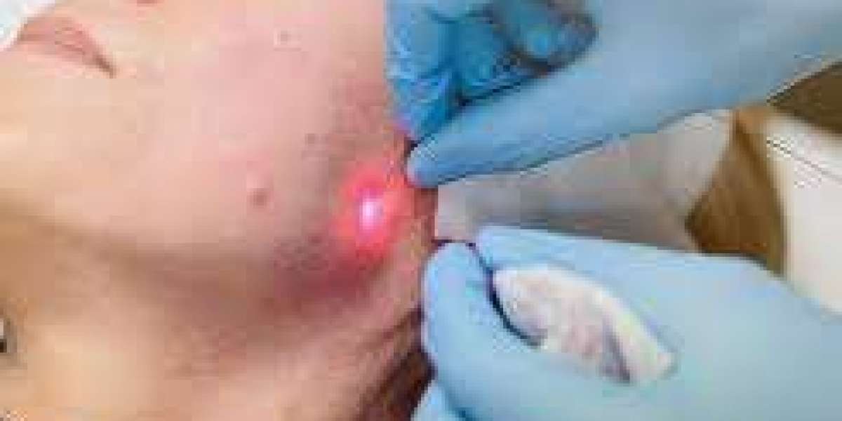Endolift Treatment in Dubai – A Modern Approach to Non-Surgical Skin Tightening