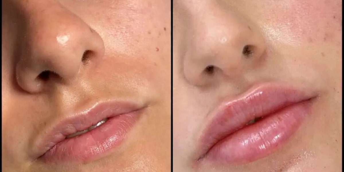 Achieve Balanced Features at the Best Aesthetic Clinic in Dubai for Fillers