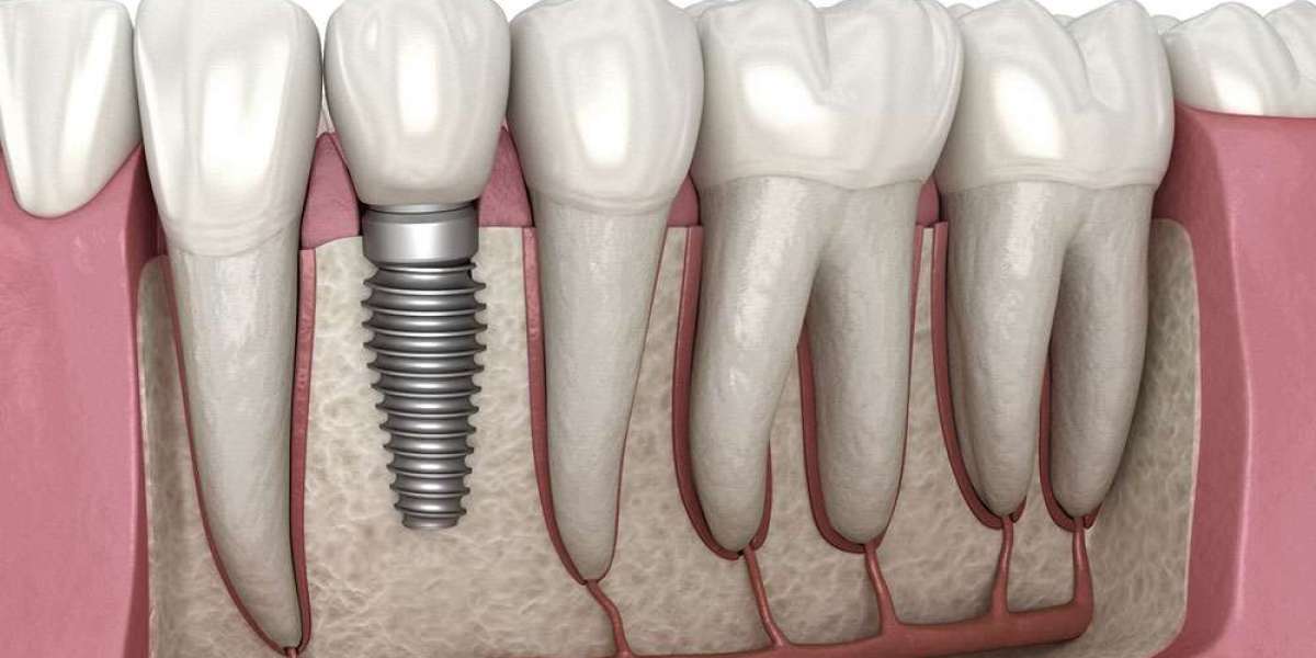 Why Dental Implants Are the Best Solution for Missing Teeth
