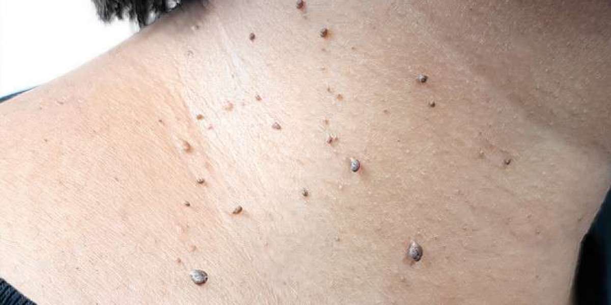 Skin Tag Removal in London: When Should You Seek Professional Help?