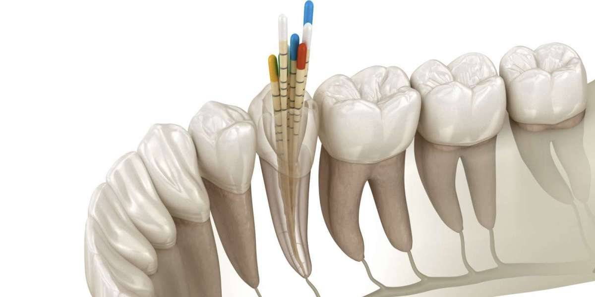 Understanding Root Canal Treatment: Signs, Treatment and Long-Term Care
