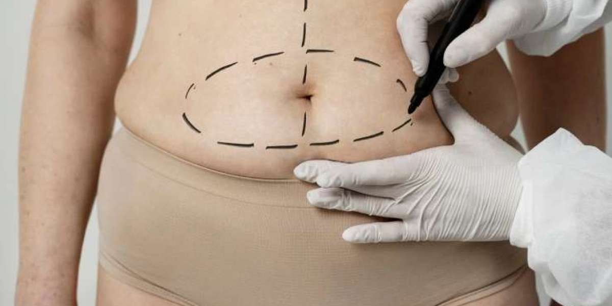 Common Misconceptions About Liposuction Surgery