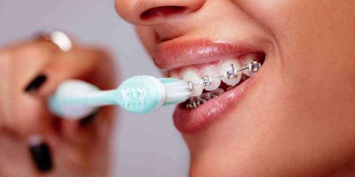 The Long-Term Benefits of Teeth Braces in Islamabad Pakistan: