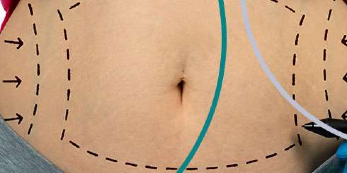 Transform Your Body Shape with Lipomatic Treatment in Riyadh