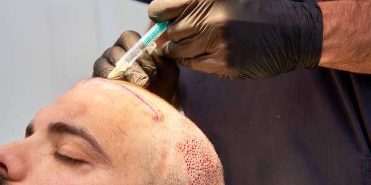 Recovery After Hair Transplant in Dubai Explained