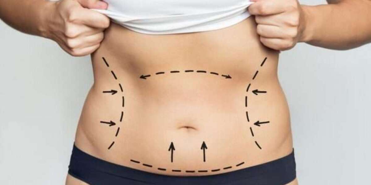 Best Doctors in Dubai Liposuction Treatments for Natural Looking Outcomes