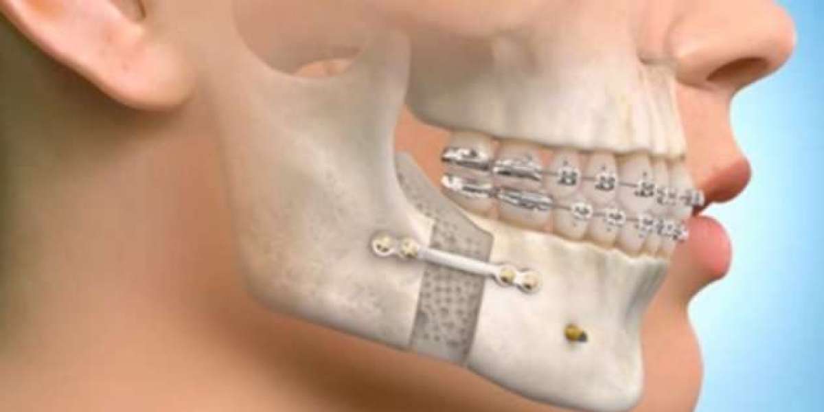 Restore Facial Symmetry with Jaw Surgery at Glam Aesthetic Clinic