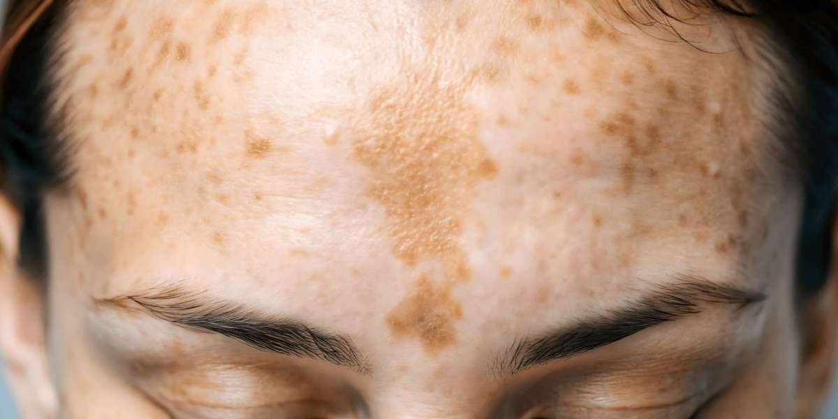 Skin Light Burst Freckles and Blemishes fade into fresh glowing radiance