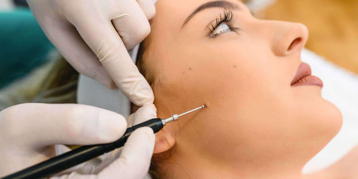 Mole Removal in London: Treatment Methods Explained