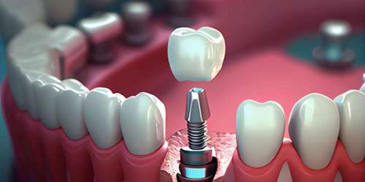 How to Care for Your Dental Implants for Long-Term Success