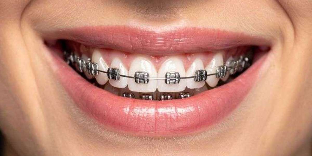 Dental Braces vs Clear Aligners: Key Differences Explained