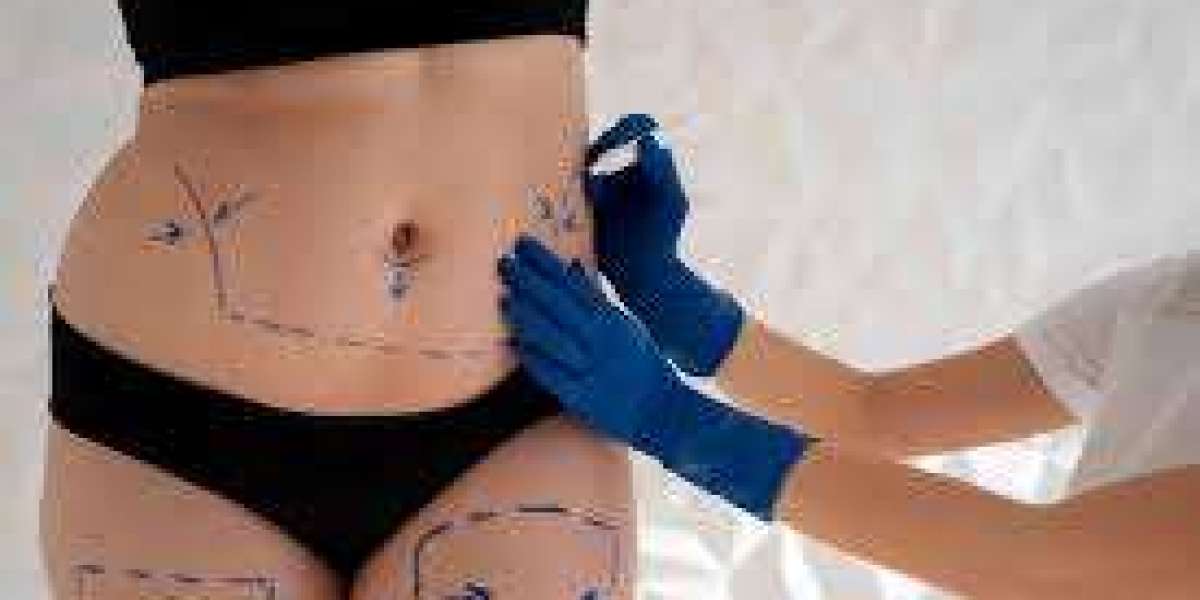 How Does Liposuction Remove Resistant Fat?