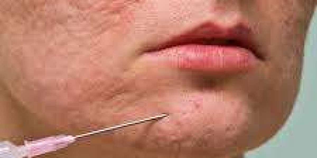 Safe and Effective Scar Removal in Dubai Techniques for Clear Skin Restoration