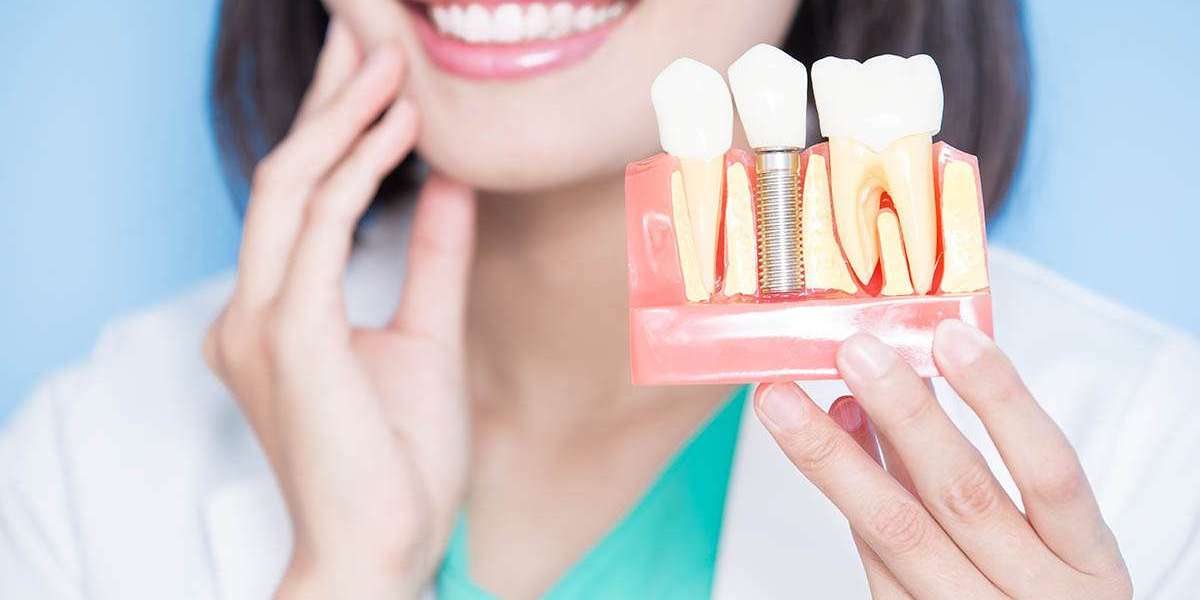 Long-Term Benefits of Choosing Dental Implants