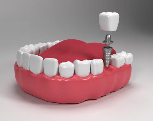Dental Implants: Functionality, Aesthetics, and Longevity Future of Tooth Replacement - Monu