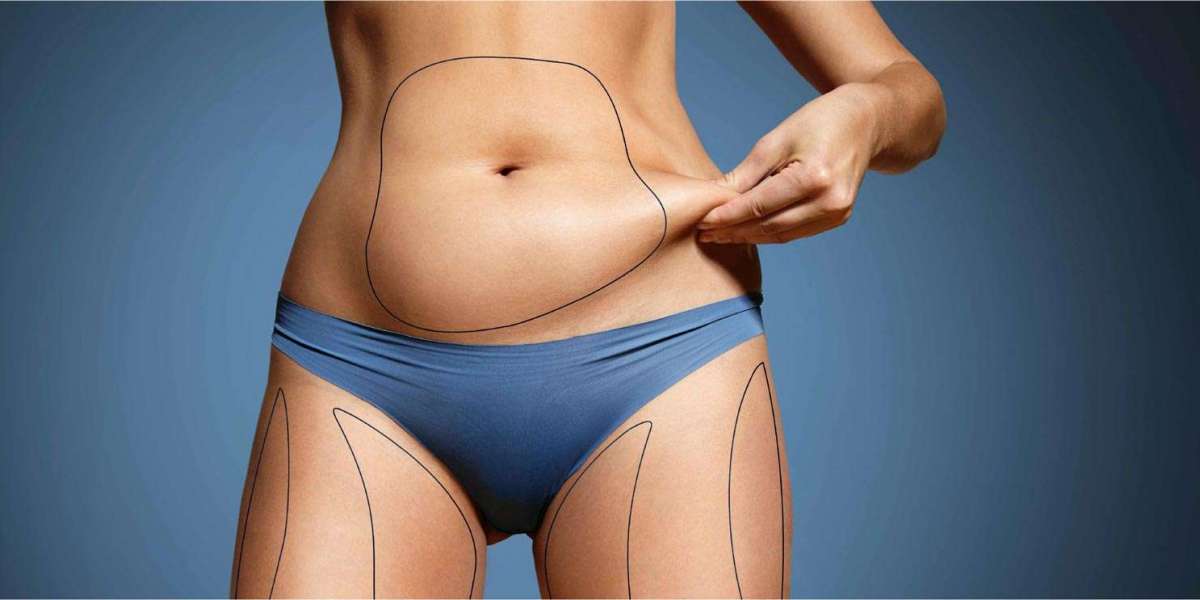 Tummy Tuck Surgery Dubai: Who Can Benefit from This Body Contouring Procedure?