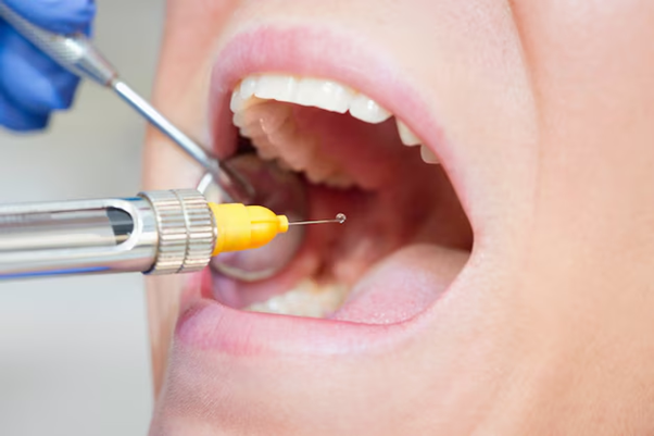 How Long Do Tooth Fillings Last? Care and Longevity