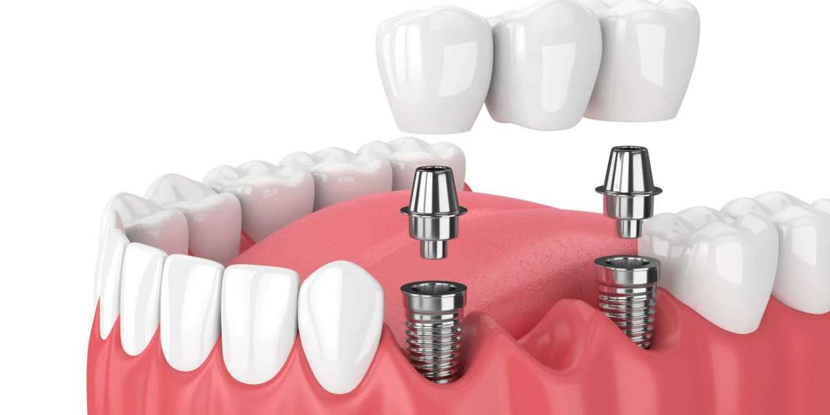 How to Care for Your Tooth Replacement for Long-Lasting Results