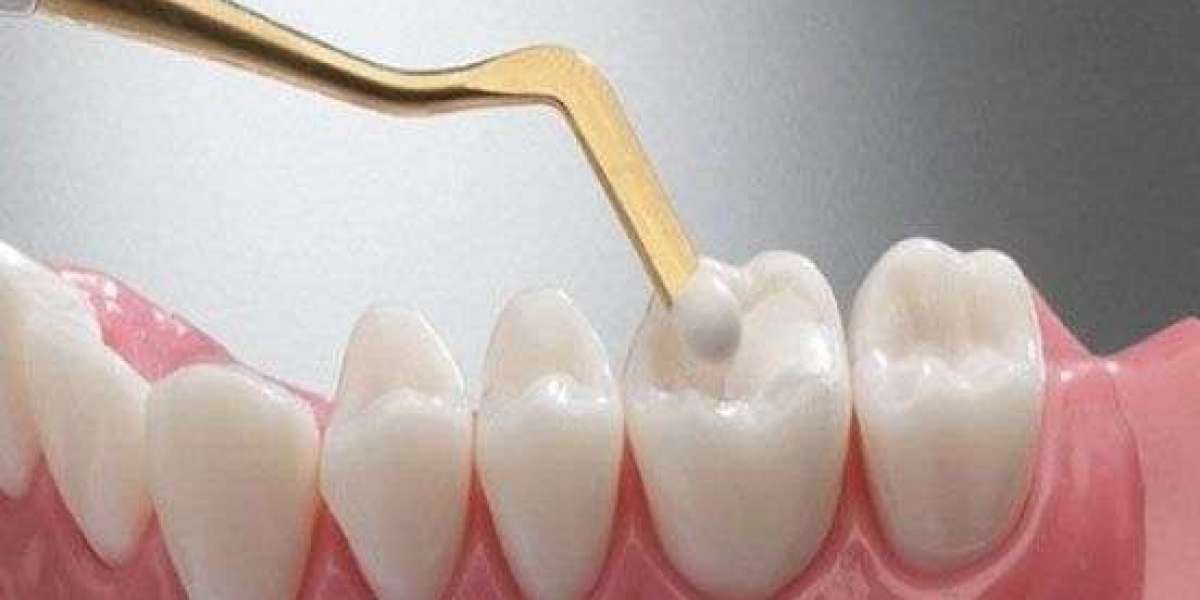 Dental Sealants: The Simple Solution for a Cavity-Free Smile