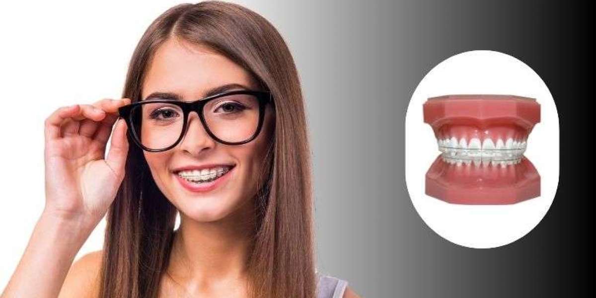 Understanding Braces Treatment: Options, Timeline and Results
