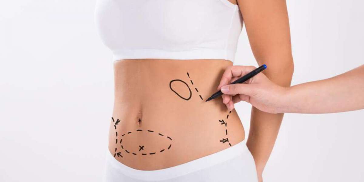 Shape Your Ideal Physique with Liposuction in Dubai