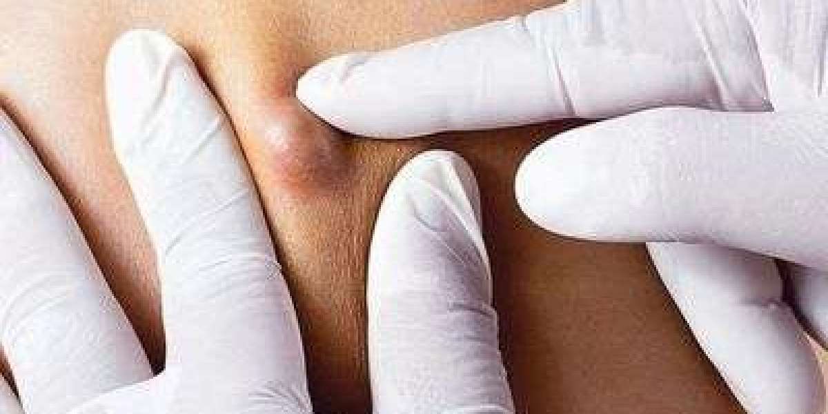Is Lipoma Treatment the Fast Solution for Refined Skin Goals?