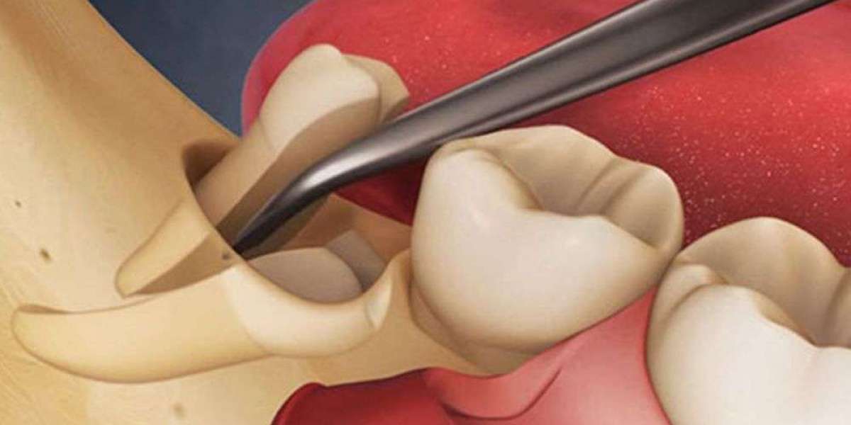 Common Problems Caused by Impacted Wisdom Teeth