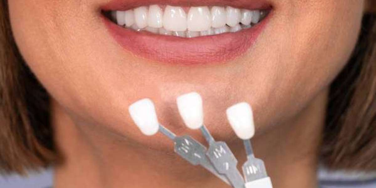 Complete Guide to Dental Veneers for a Perfect Smile