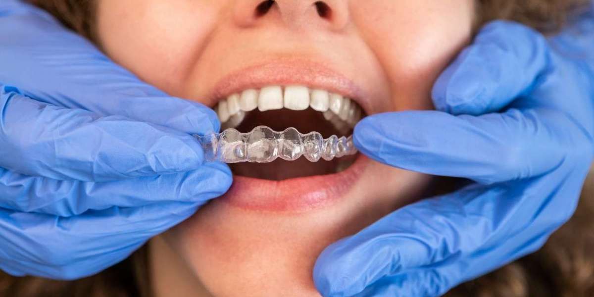 Top Benefits of Choosing Invisible Braces for Teeth Alignment