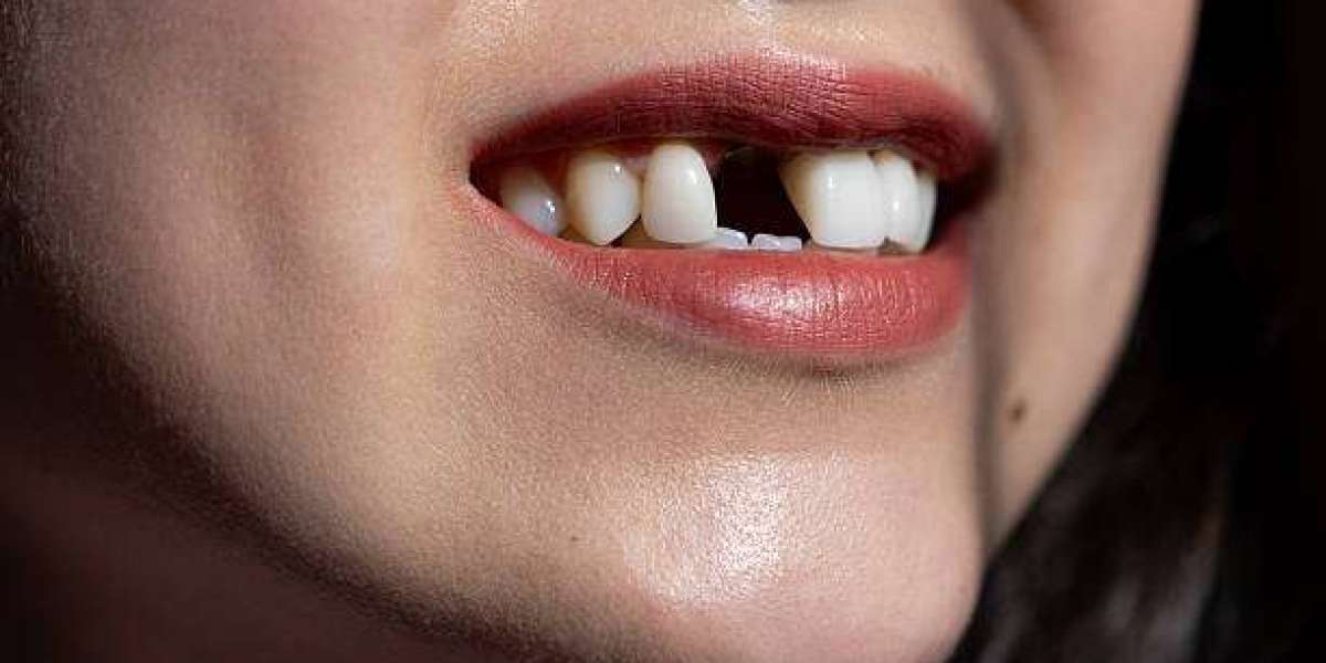 Everything You Need to Know About Saving a Damaged Tooth Tooth Fracture Treatment in Pakistan:
