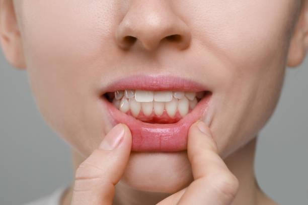 Cost vs. Results: Is Expensive Gum Recession Treatment Better? |...
