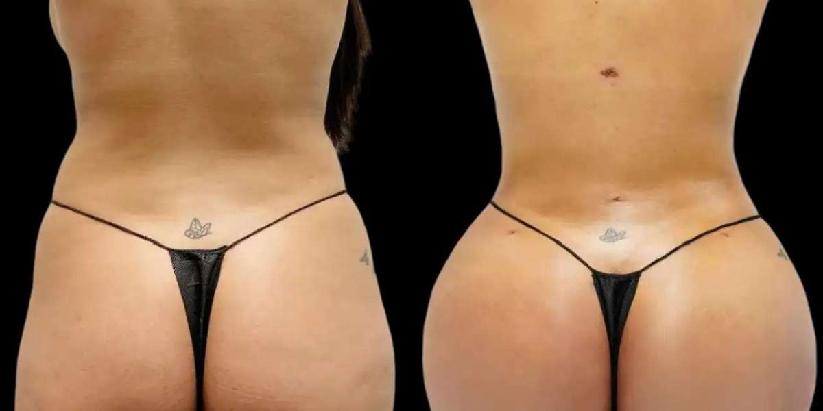 Fat Transfer for Younger-Looking Skin with the Best Fat Transfer Surgeon in Dubai