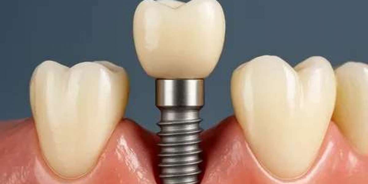 Best Tooth Replacement Option for Missing Teeth