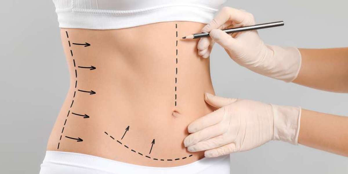 The Difference Between Traditional and Modern Liposuction in Riyadh